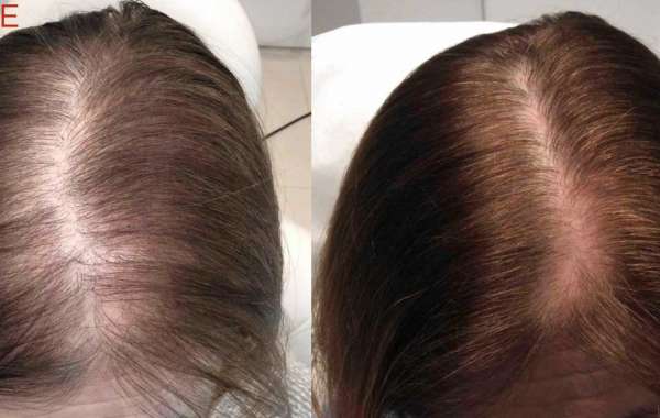 Male or Female Pattern Baldness