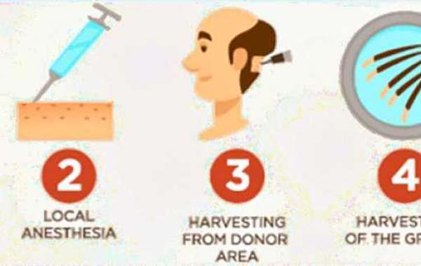 Palm springs fut hair restoration