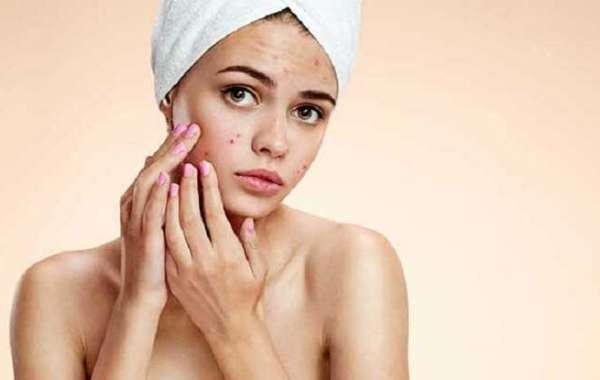 Is Vitamin A good for acne?