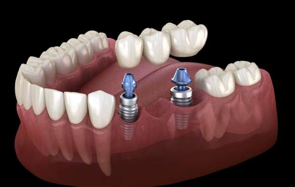Top Oral Hygiene Practices to Preserve Dental Crowns and Bridges