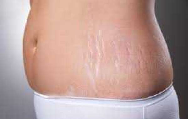 Stretch Marks Treatment Market to reach a valuation of US$ 4.6 billion by the end of 2033.