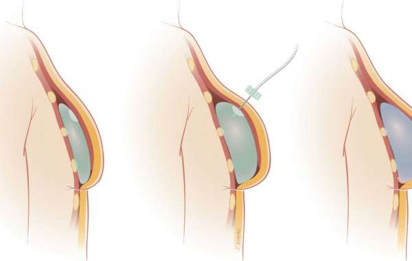 Gastric Band Surgery in Turkey, Prices of Istanbul Clinics