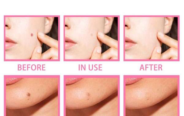 Super Luxe Skin Tag Remover