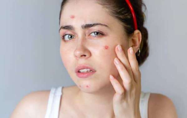 Why Early Treatment Of Acne Is Important