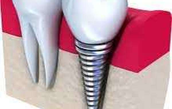 The Process of Dental Implant Position