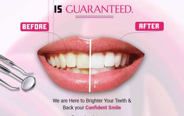 Transform Your Smile with Effective Teeth Whitening Treatment