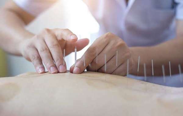 Dry Needle Therapy: An Effective Approach to Pain Relief in Murfreesboro’s Trusted Chiropractor