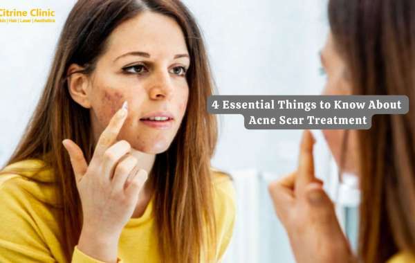 4 Essential Things to Know About Acne Scar Treatment