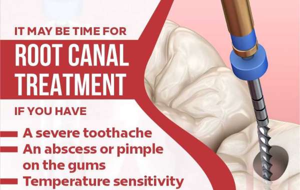 Root Canal Centre in Dwarka | Best Root Canal Treatment in Dwarka | Apex Dental