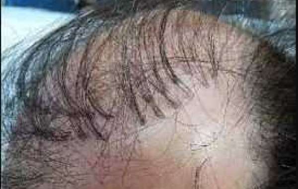Hair Plugins near Me, FUE Hair Transplant near Me, and Regrow Hair near Me: A Comprehensive Guide