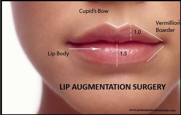 Four Facts to Know About Lip Augmentation
