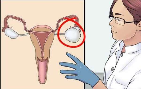 Biến chứng, Chẩn đoán và Thuốc điều trị u nang buồng trứng
