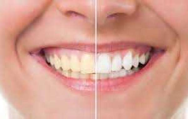 Achieving a Radiant Smile with Laser Teeth Whitening: An Advanced Dental Solution