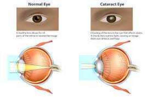 Best Cataract Eye Surgery in Bharti Eye Foundation