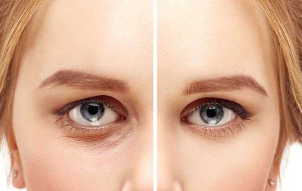ENHANCING YOUR EYES WITH UPPER EYELID FILLERS: A PATH TO REJUVENATION