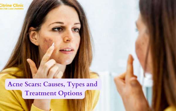 Acne Scars: Causes, Types and Treatment Options