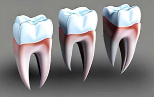 Dental Implant treatment in india