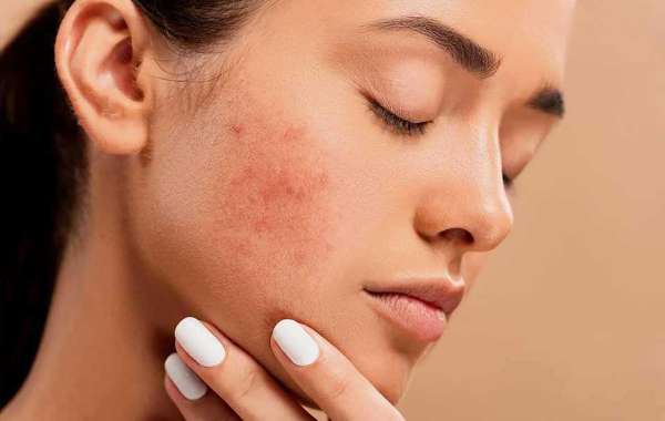 Embrace Clear, Radiant Skin: Acne Treatment in Singapore
