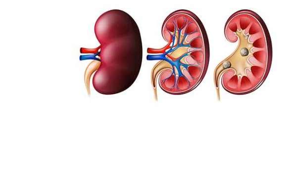 Is it Safe to Live With Kidney Stones?