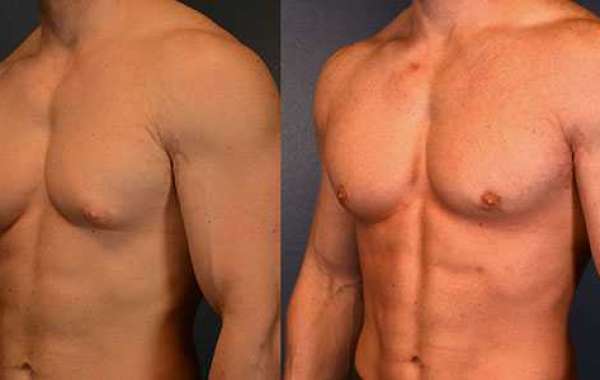 Gynecomastia Surgery: A Path to Confidence and Well-being