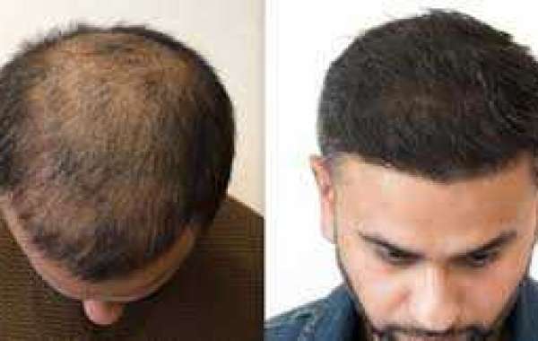 Hair Transplant After 14 Days: Pictures, Results, and Side Effects