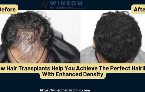 How Hair Transplants Help You Achieve The Perfect Hairline With Enhanced Density