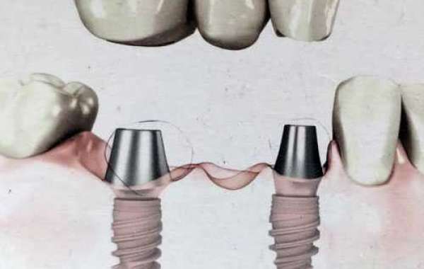 Dental implant cost in Delhi