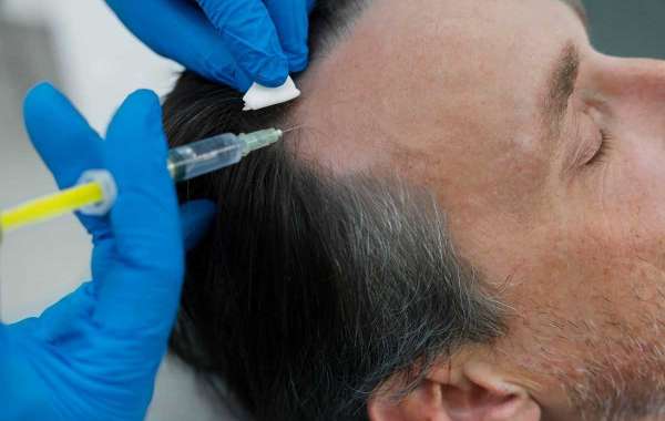 What Is PRP Hair Treatment and How Does It Help With Hair Loss?